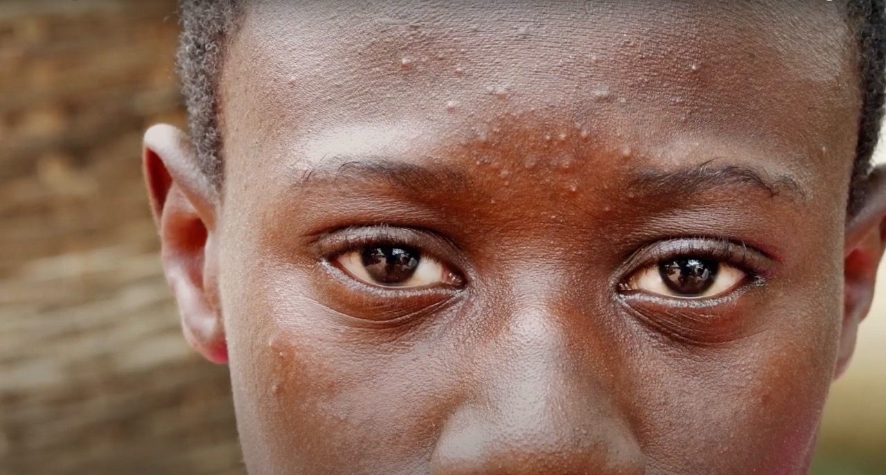 Thumbnail of child's eyes